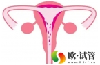 为什么试管也会出现生化妊娠导致试管不成功